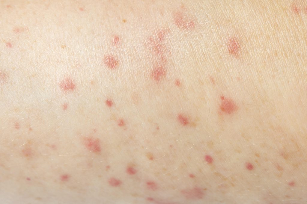 Person Having Skin Allergy Close Up 1